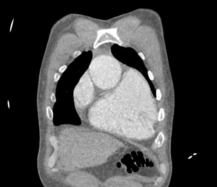 File:Ascending aortic aneurysm (Radiopaedia 86279-102297 B 7).jpg