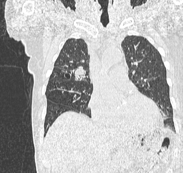File:Aspergilloma (Radiopaedia 44592-48327 Coronal lung window 44).jpg