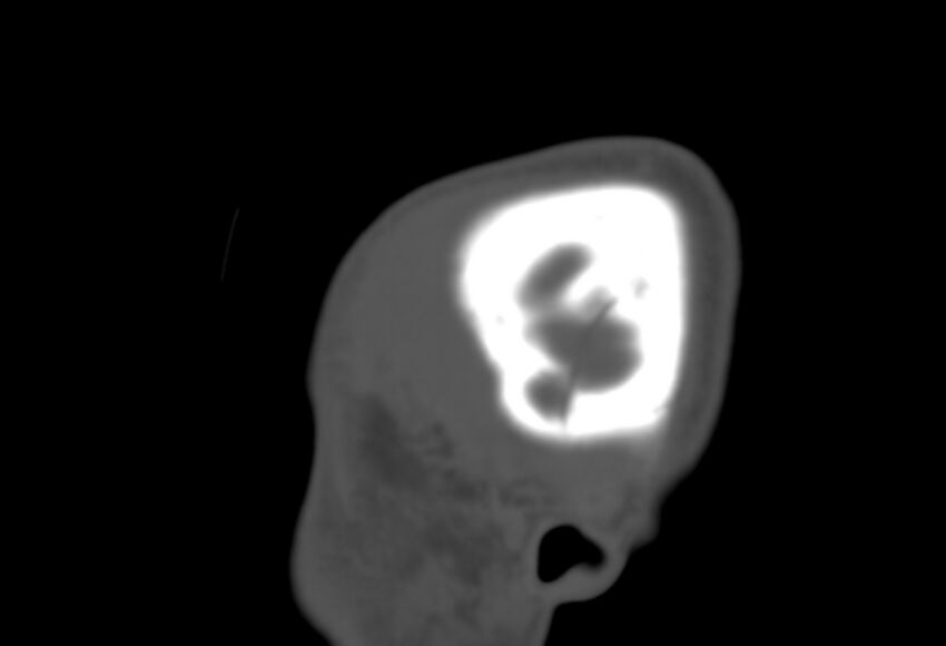 Asymptomatic occipital spur (Radiopaedia 87753-104201 Sagittal bone window 4).jpg