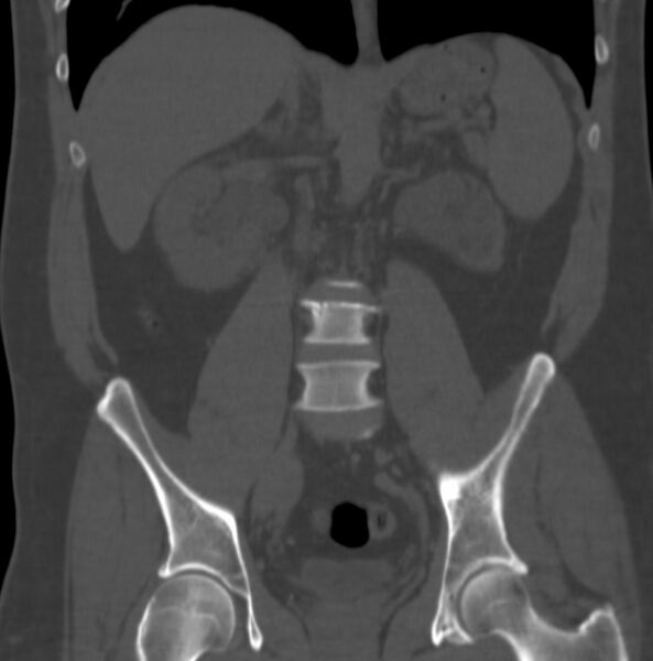 File:Atrophic kidney due to severe chronic obstructive hydronephrosis (Radiopaedia 40828-43474 Coronal bone window 5).jpg