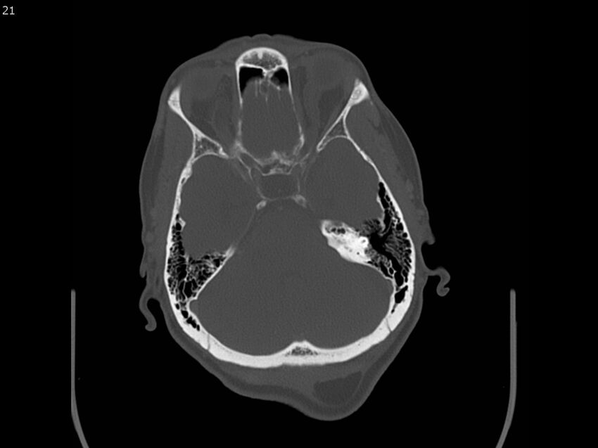 Atypical meningioma - intraosseous (Radiopaedia 64915-73867 Axial C+ bone window 21).jpg