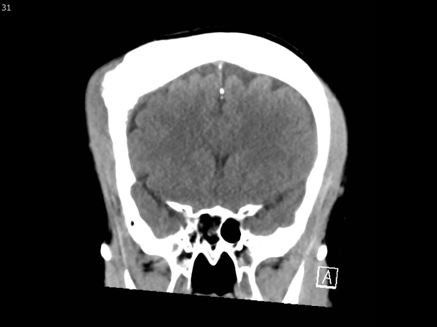 Atypical meningioma - intraosseous (Radiopaedia 64915-73867 B 30).jpg