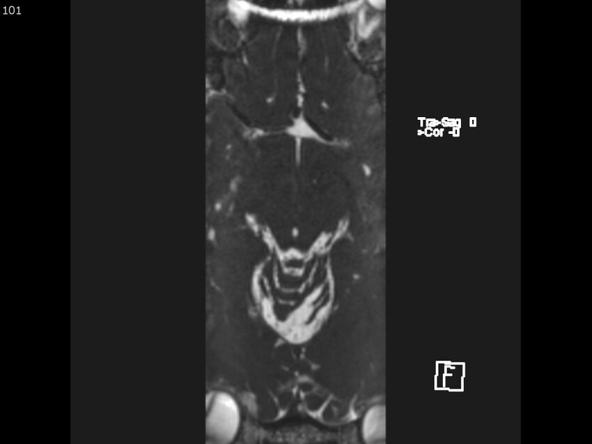 Atypical meningioma - intraosseous (Radiopaedia 64915-74572 Axial CISS 101).jpg