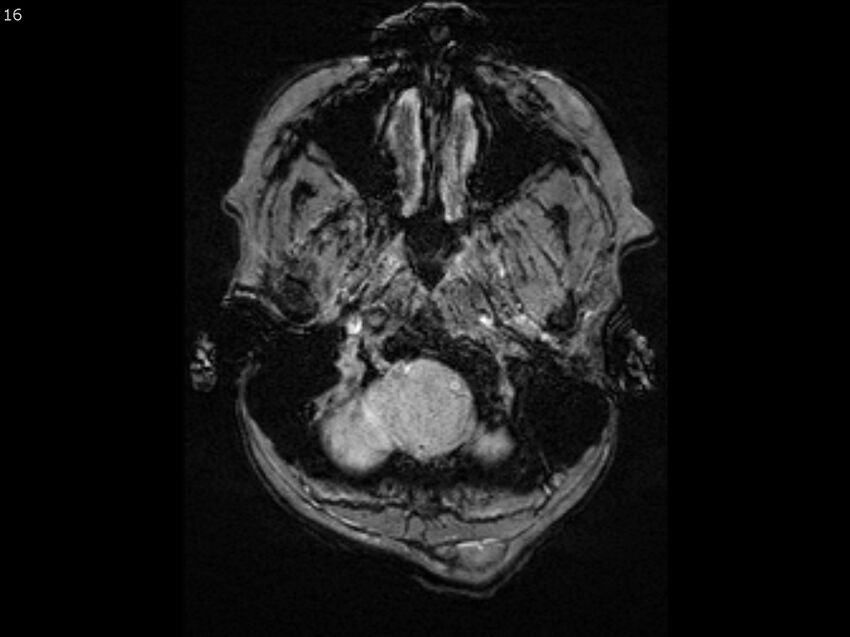 Atypical meningioma - intraosseous (Radiopaedia 64915-74572 Axial SWI 16).jpg