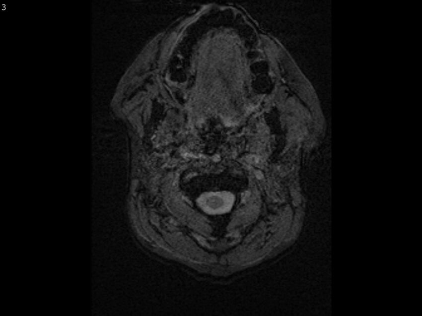Atypical meningioma - intraosseous (Radiopaedia 64915-74572 Axial SWI 3).jpg