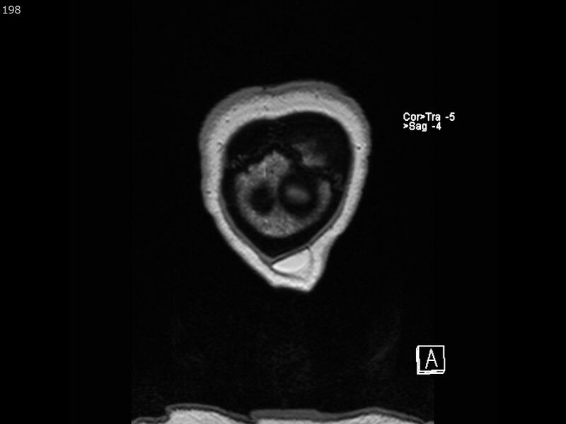 File:Atypical meningioma - intraosseous (Radiopaedia 64915-74572 Coronal T1 198).jpg