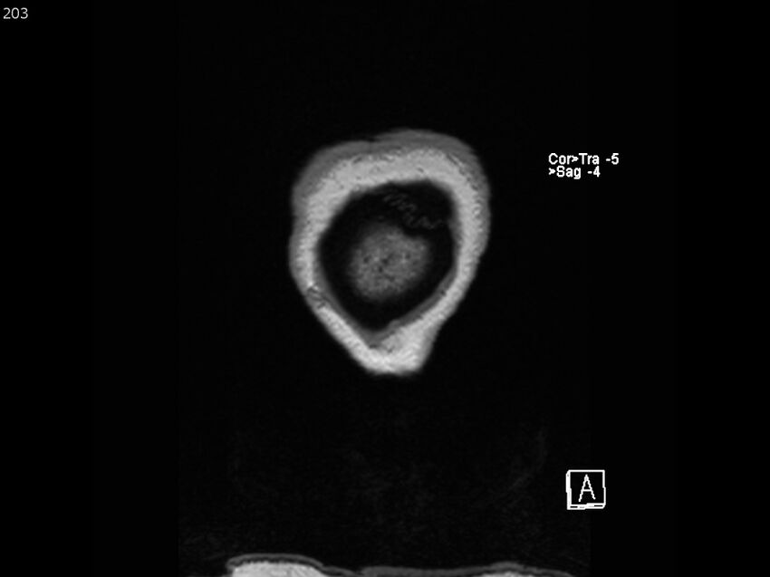 Atypical meningioma - intraosseous (Radiopaedia 64915-74572 Coronal T1 203).jpg