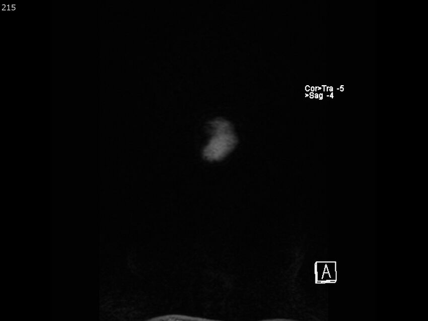Atypical meningioma - intraosseous (Radiopaedia 64915-74572 Coronal T1 215).jpg