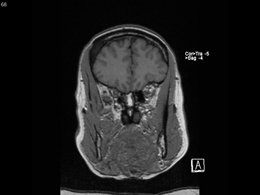 Atypical meningioma - intraosseous (Radiopaedia 64915-74572 Coronal T1 68).jpg