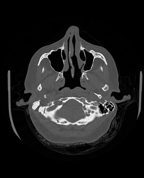 File:Automastoidectomy with labyrinthine fistula (Radiopaedia 84143-99411 Axial non-contrast 60).jpg