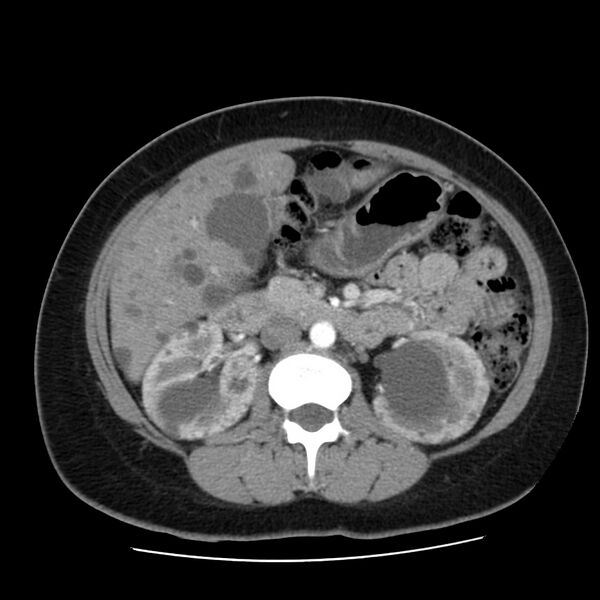 File:Autosomal dominant polycystic kidney disease (Radiopaedia 23061-23093 B 29).jpg