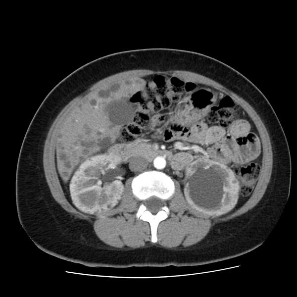 File:Autosomal dominant polycystic kidney disease (Radiopaedia 23061-23093 B 31).jpg