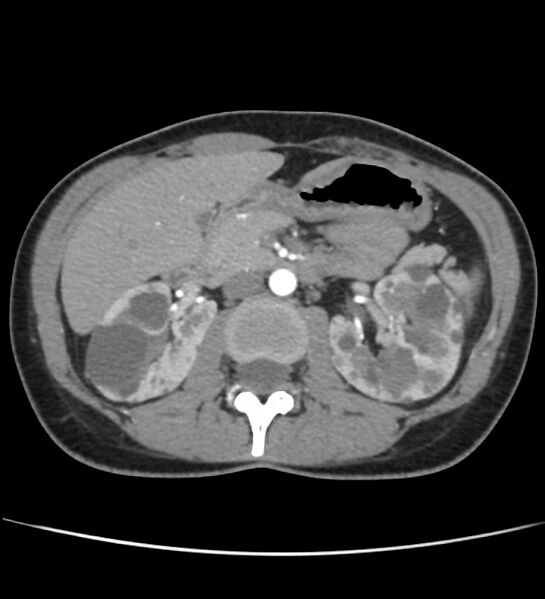 File:Autosomal dominant polycystic kidney disease - early onset (Radiopaedia 40734-43387 B 21).jpg