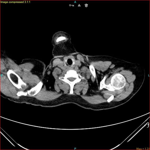 File:Azygos vein aneurysm (Radiopaedia 77824-90130 A 3).jpg