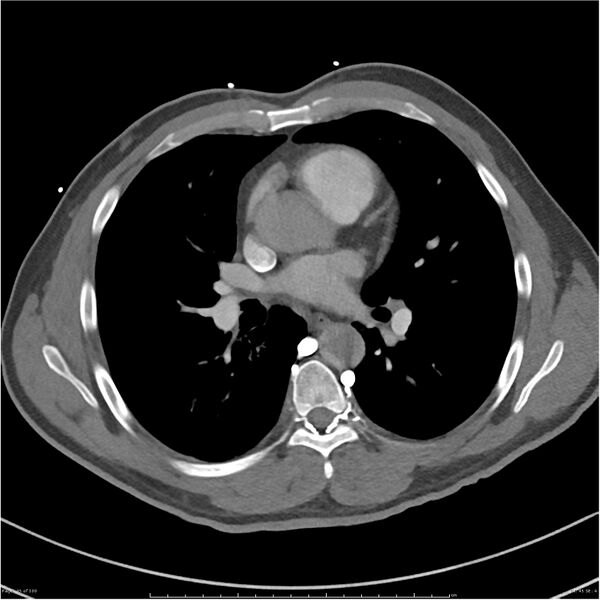 File:Azygos venous system anatomy (CT pulmonary angiography) (Radiopaedia 25928-26077 Axial C+ CTPA 45).jpg