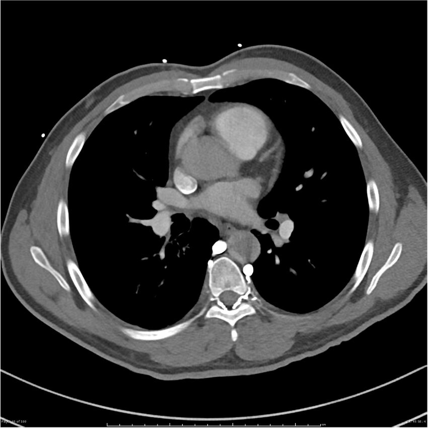 Azygos venous system anatomy (CT pulmonary angiography) (Radiopaedia 25928-26077 Axial C+ CTPA 45).jpg