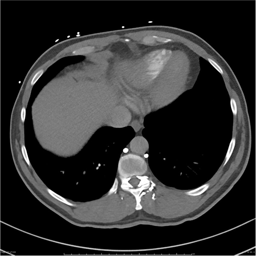 Azygos venous system anatomy (CT pulmonary angiography) (Radiopaedia 25928-26077 Axial C+ CTPA 72).jpg