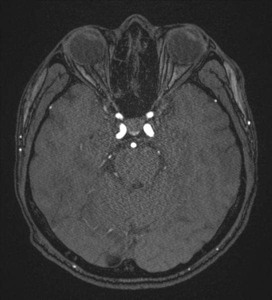 File:Basal ganglia subacute infarct (Radiopaedia 80201-93521 Axial MRA 40).png