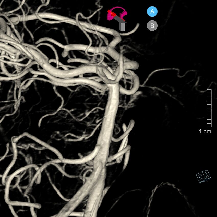 Basilar artery perforator aneurysm (Radiopaedia 82455-97734 3D view left VA 55).jpg