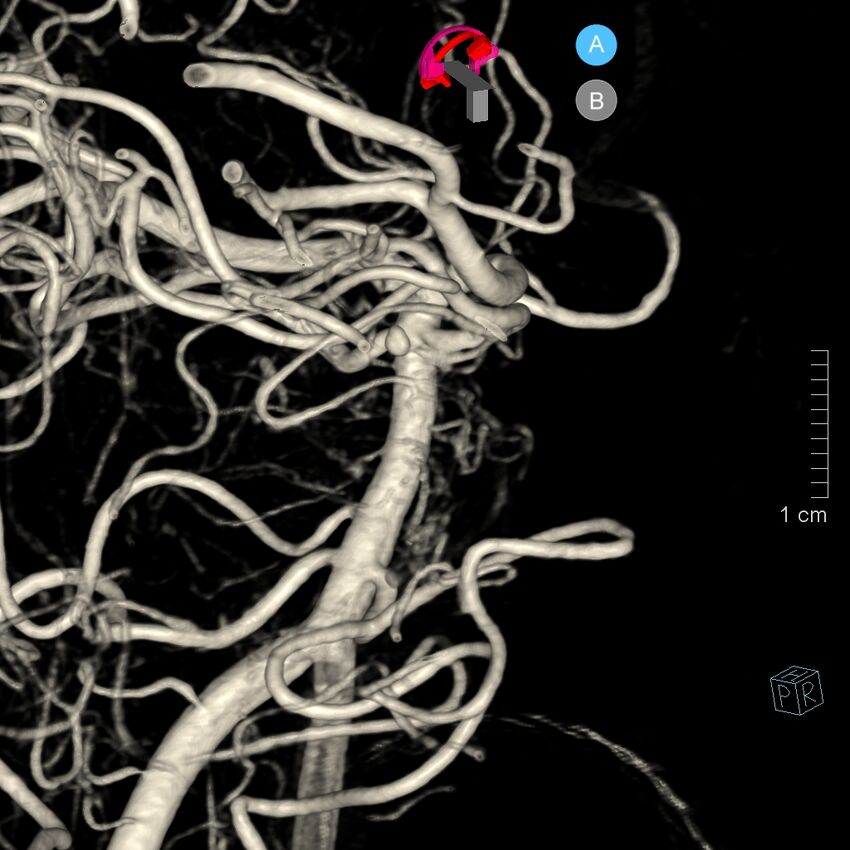 Basilar artery perforator aneurysm (Radiopaedia 82455-97734 3D view left VA 76).jpg