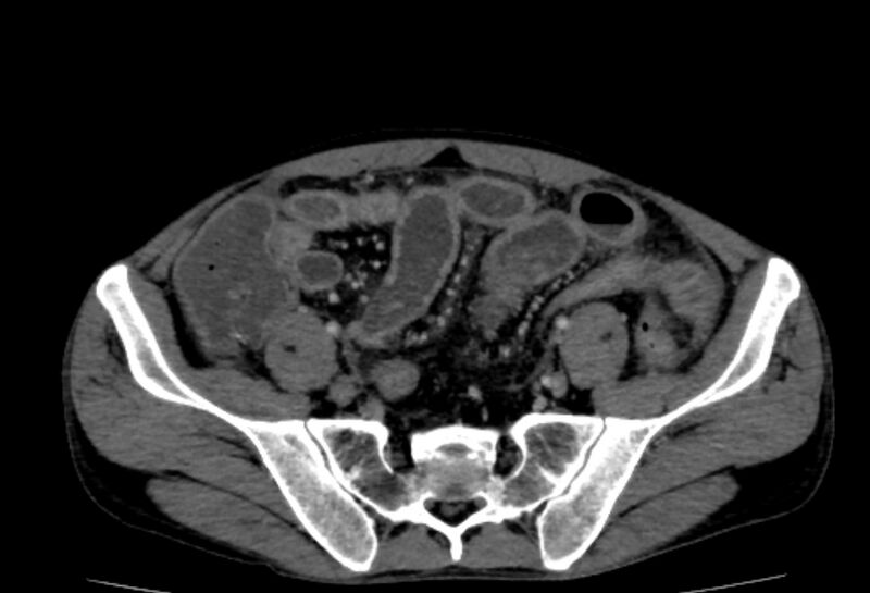 File:Behçet's disease- abdominal vasculitis (Radiopaedia 55955-62570 A 68).jpg