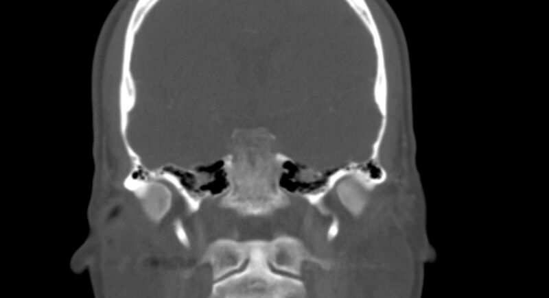 File:Benign mixed salivary tumor of the parotid gland (Radiopaedia 35261-36792 Coronal bone window 18).jpg