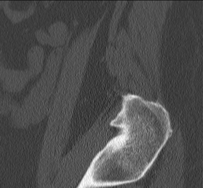 File:Bertolotti syndrome (Radiopaedia 24864-25128 Sagittal bone window 4).jpg