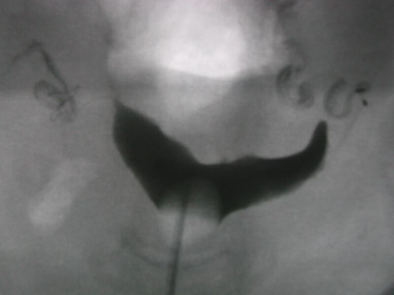 File:Bicornuate uterus (Radiopaedia 23613-23732 B 1).JPG