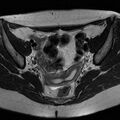 Bicornuate uterus (Radiopaedia 72135-82643 Axial T2 9).jpg