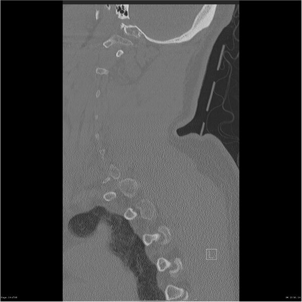 File:Bilateral cervical ribs (Radiopaedia 25868-26017 Sagittal bone window 14).jpg
