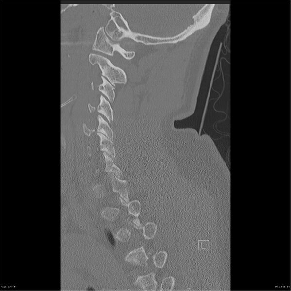 File:Bilateral cervical ribs (Radiopaedia 25868-26017 Sagittal bone window 22).jpg