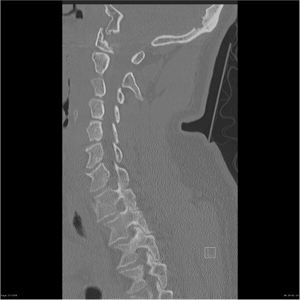 File:Bilateral cervical ribs (Radiopaedia 25868-26017 Sagittal bone window 27).jpg