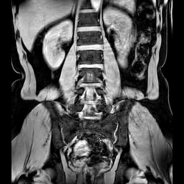 File:Bilateral conjoined nerve roots at different levels (Radiopaedia 73312-84063 Coronal WE 28).jpg