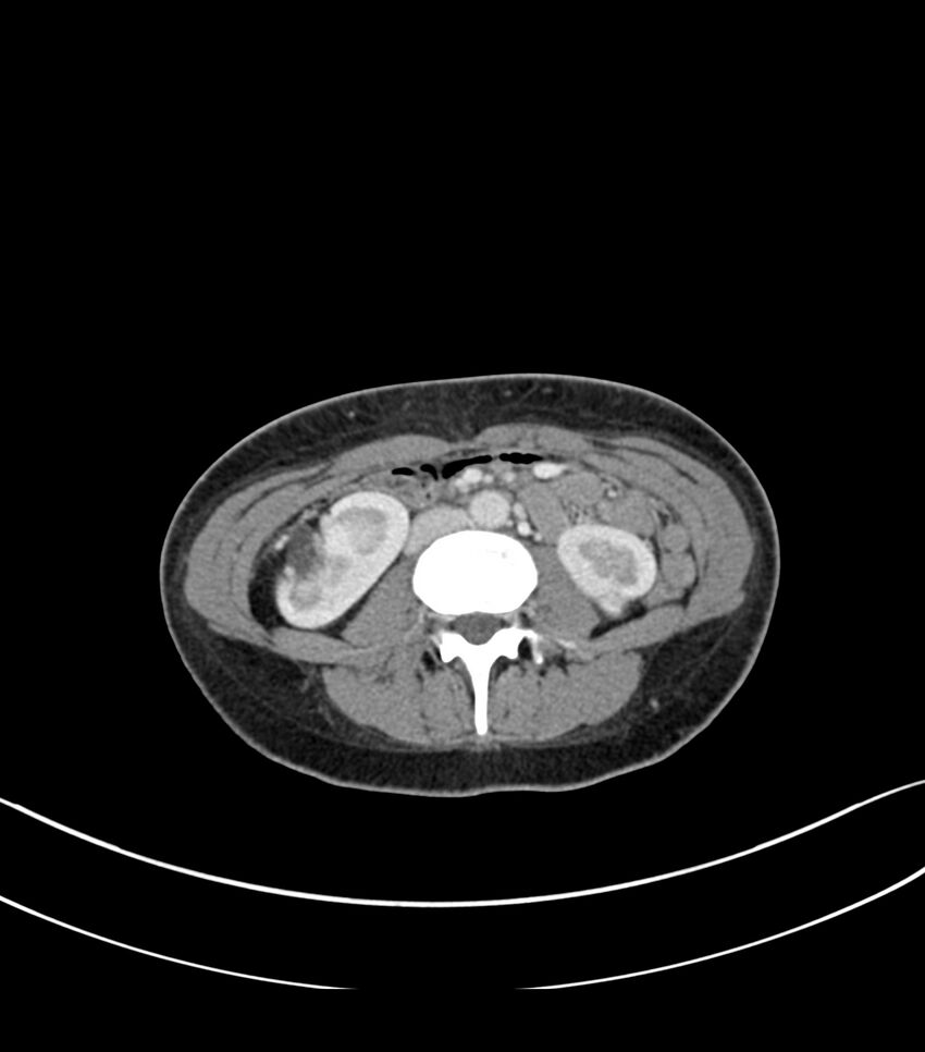 Bilateral kidney malrotation (Radiopaedia 72227-82749 A 32).jpg