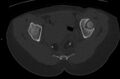 Bilateral mature cystic ovarian teratoma (Radiopaedia 88821-105592 Axial bone window 31).jpg