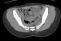 Bilateral mature cystic ovarian teratoma (Radiopaedia 88821-105592 Axial non-contrast 10).jpg