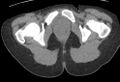 Bilateral mature cystic ovarian teratoma (Radiopaedia 88821-105592 Axial non-contrast 60).jpg