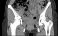Bilateral mature cystic ovarian teratoma (Radiopaedia 88821-105592 Coronal non-contrast 5).jpg