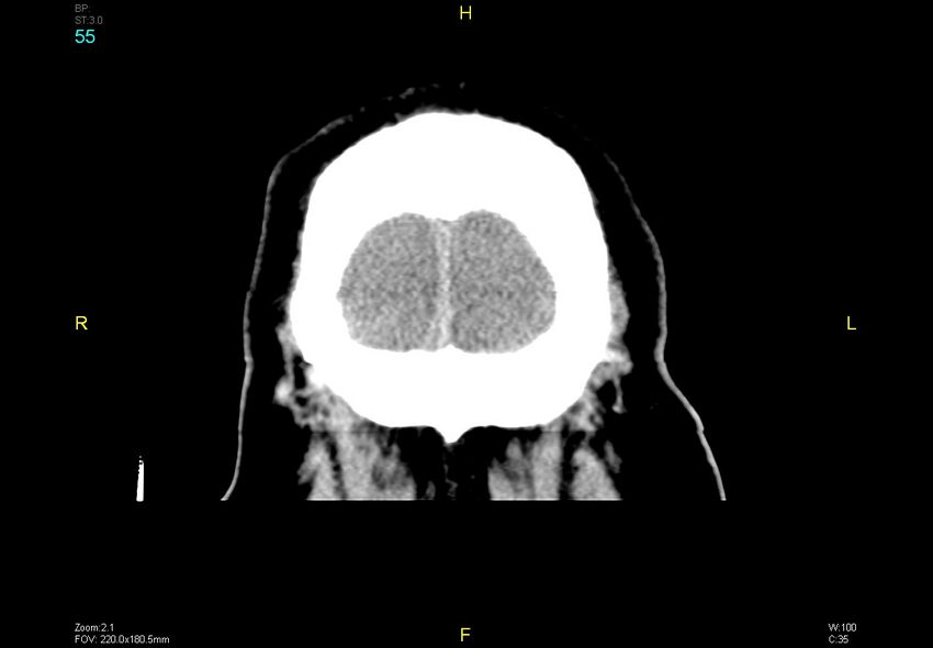 Bilateral medial medullary infarction (Radiopaedia 42220-45295 Coronal non-contrast 55).jpg