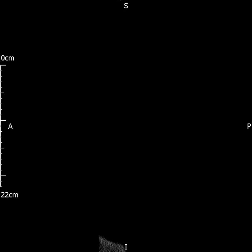 Bilateral medullary nephrocalcinosis with ureteric calculi (Radiopaedia 71269-81569 C 117).jpg
