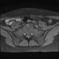 Bilateral ovarian endometriomas (Radiopaedia 87085-103347 Axial T1 fat sat 2).jpg