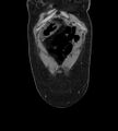 Bilateral ovarian mature cystic teratomas (Radiopaedia 79373-92457 B 3).jpg