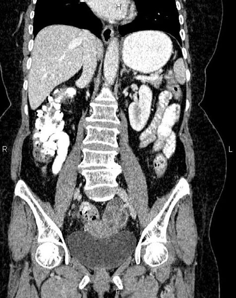 File:Bilateral ovarian serous cystadenocarcinoma (Radiopaedia 86062-101989 D 26).jpg