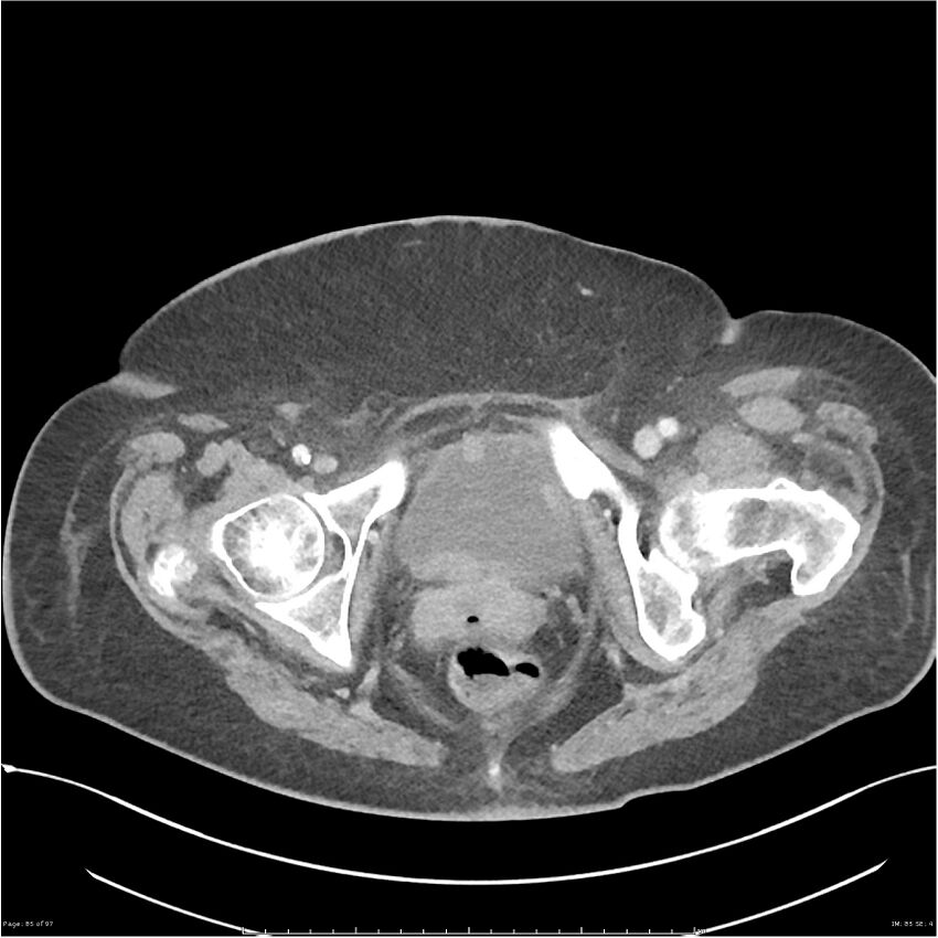 Bilateral psoas hematomas (Radiopaedia 24057-24279 A 85).jpg