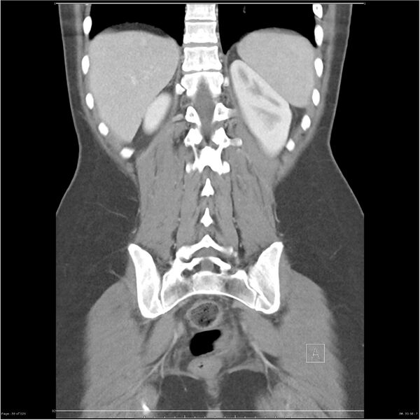 File:Bilateral ureteritis and cystitis (Radiopaedia 25340-25594 B 30).jpg