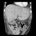 Biliary necrosis - liver transplant (Radiopaedia 21876-21846 C 9).jpg