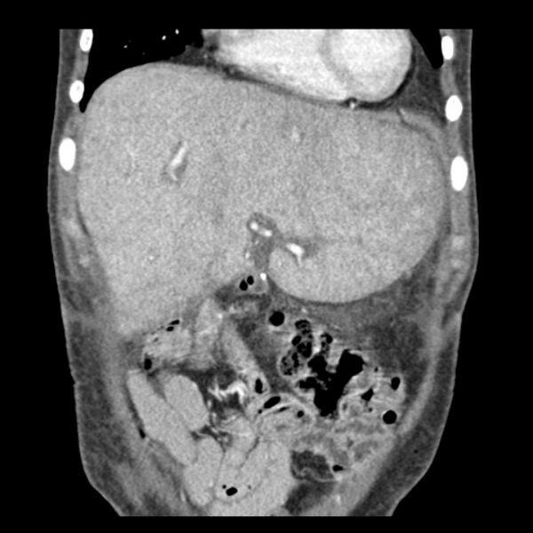File:Biliary necrosis - liver transplant (Radiopaedia 21876-21846 C 9).jpg
