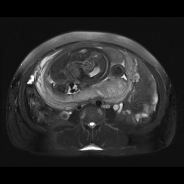 File:Bilobed placenta accreta (Radiopaedia 69648-79591 Axial T2 fat sat 19).jpg
