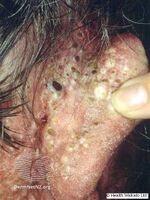 Blackheads and cysts (DermNet NZ acne-chloracne2).jpg