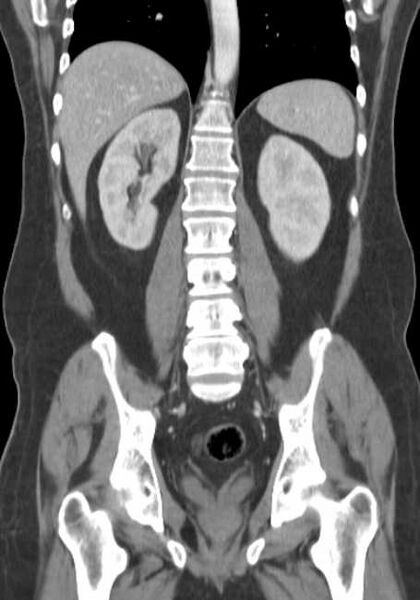 File:Bleeding duodenal ulcer and adenomyomatosis of gallbladder (Radiopaedia 61834-69861 B 28).jpg